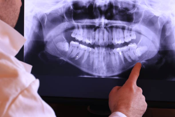 Best Emergency Wisdom Tooth Extraction in Pinedale, WY